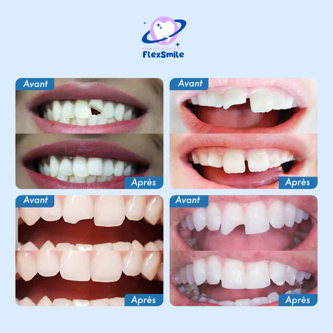 Flex-Smile® - Tandheelkundige reparatieset - Ma boutique